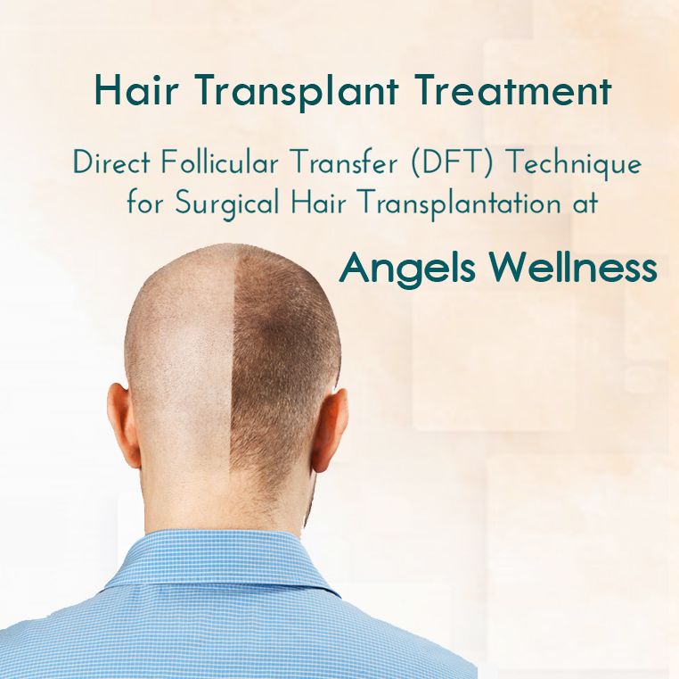 Best Hair Transplantation Treatment | HAIR TRANSPLANTATION | FUE HAIR  TRANSPLANTATION 